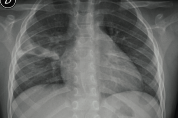 Opacité persistante sur la radiographie thoracique : à quoi penser ?