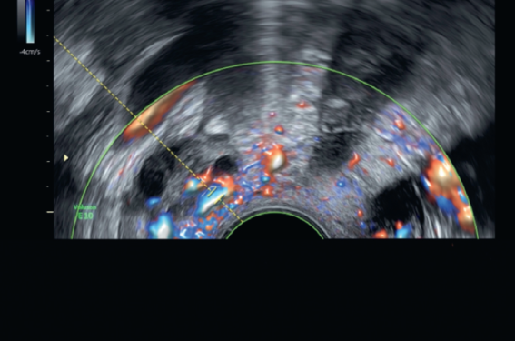Dilatations veineuses pelviennes Dilatations veineuses pelviennes